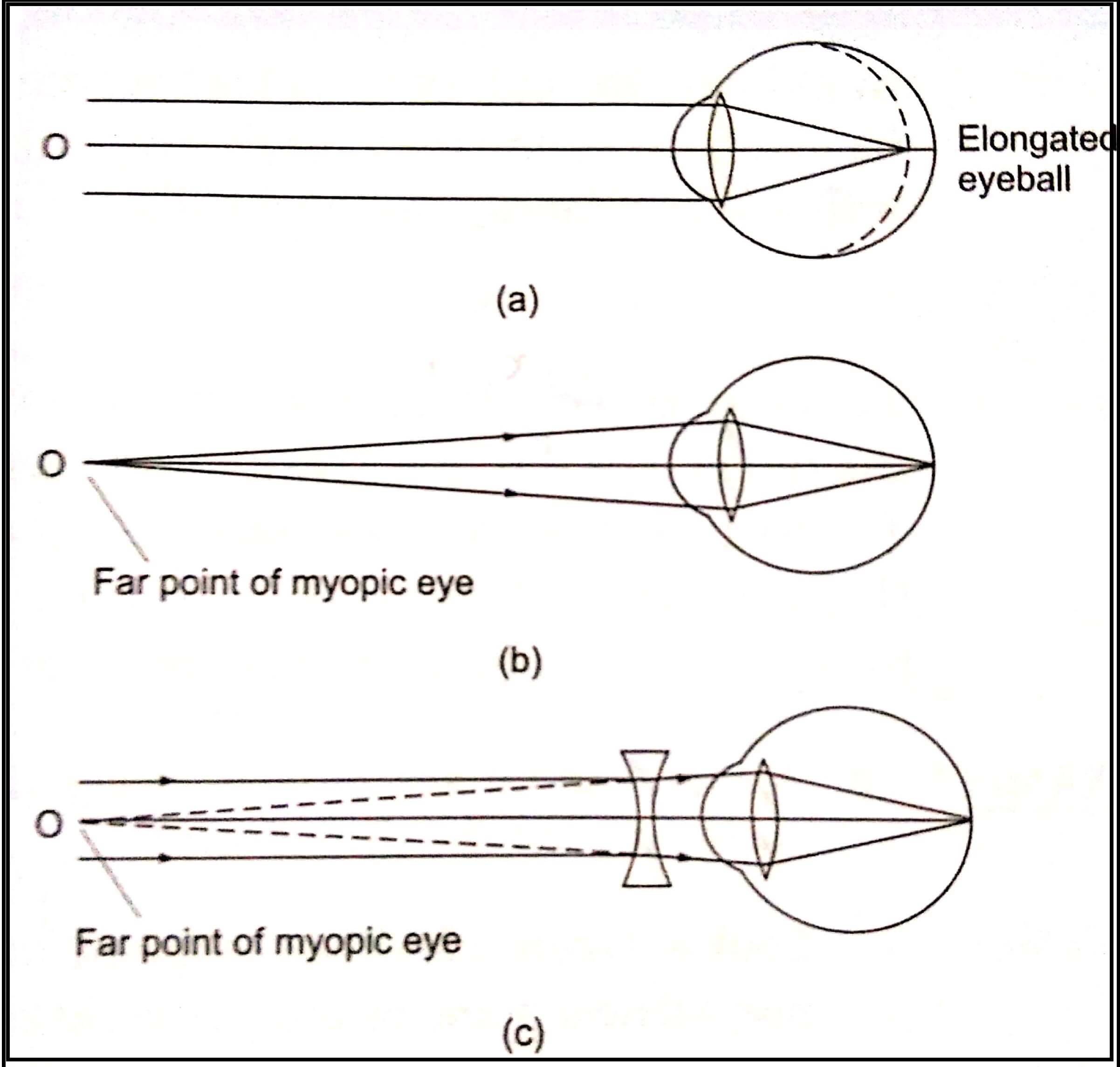 Near Sightedness Myopia Human Eye